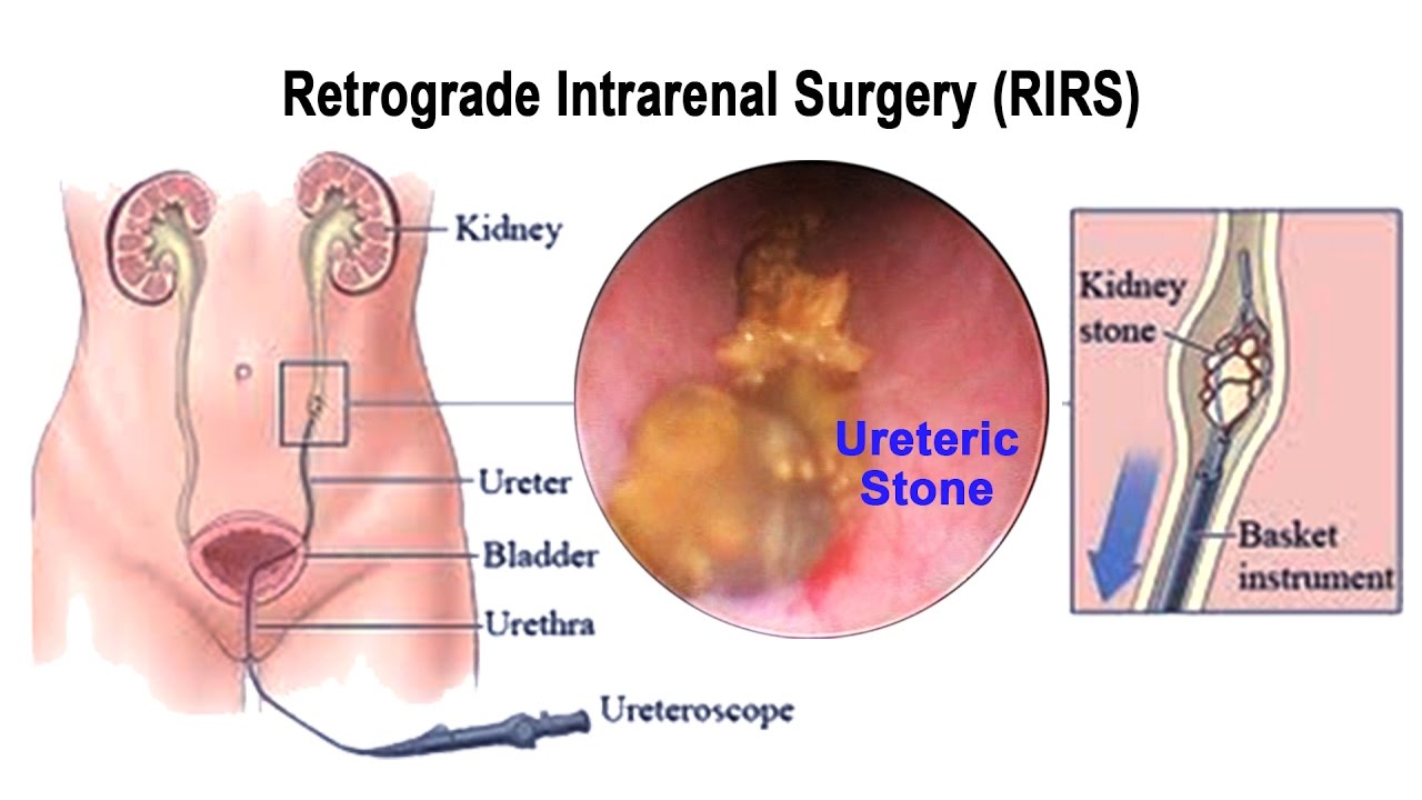 Laser treatment of kidney Stone In Pune